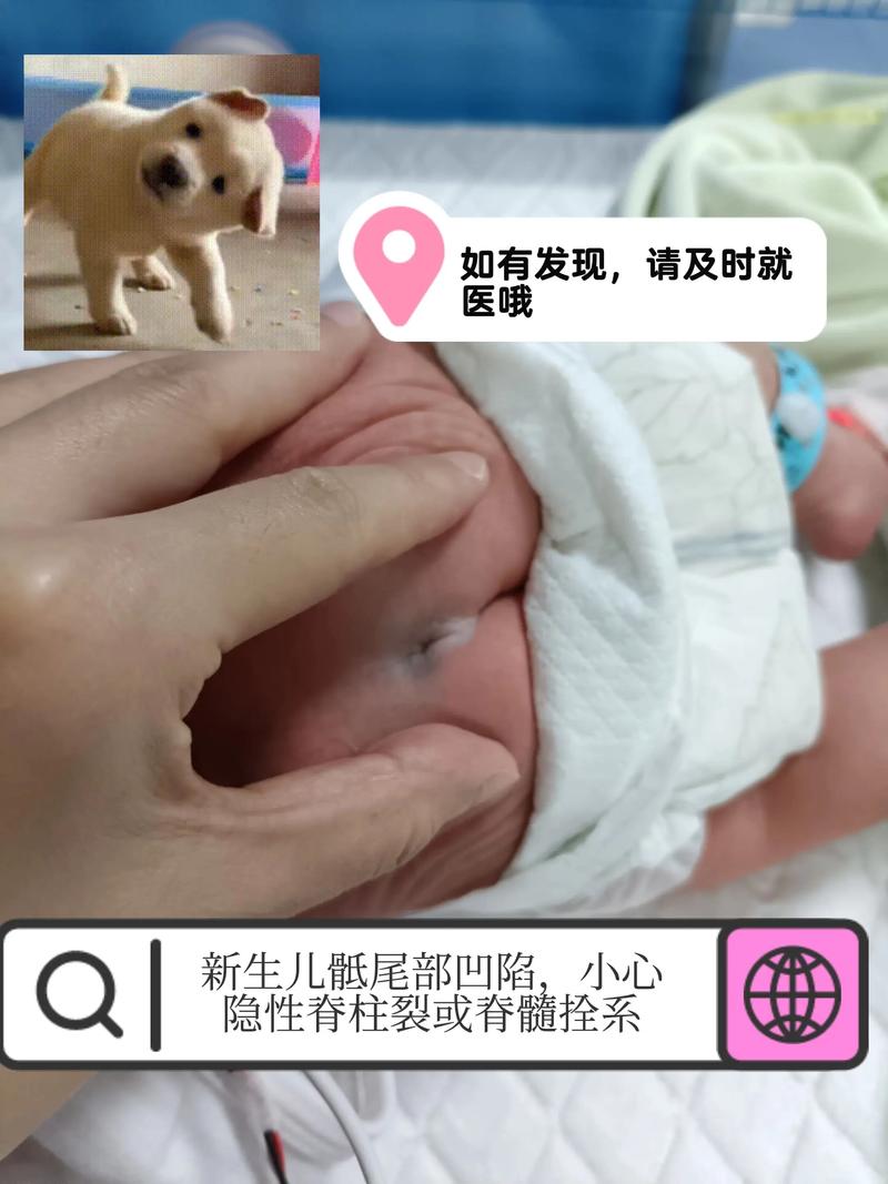新生儿骶尾凹陷综合症是先天畸形吗？如何诊断与治疗？-第1张图片-郑州医学网