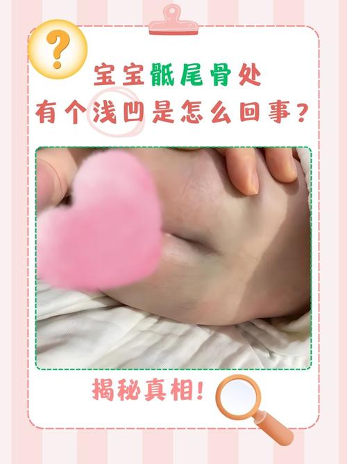 新生儿骶尾凹陷综合症是先天畸形吗？如何诊断与治疗？-第2张图片-郑州医学网