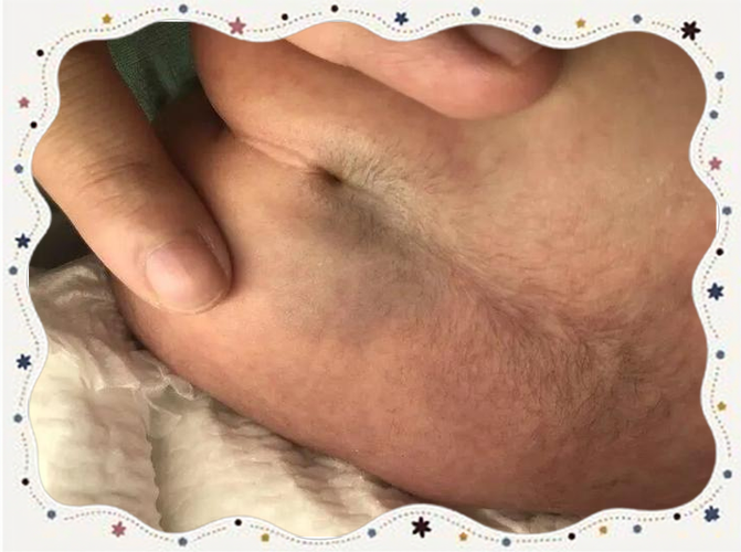 新生儿骶尾凹陷综合症是先天畸形吗？如何诊断与治疗？-第3张图片-郑州医学网