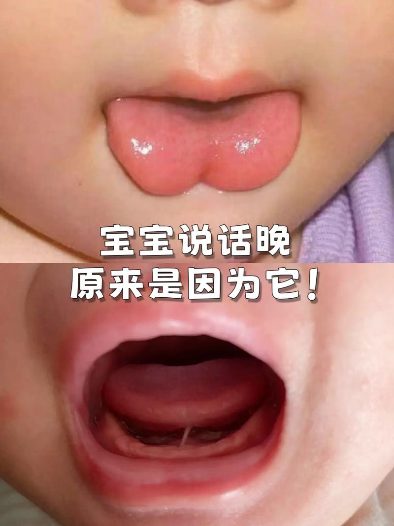 新生儿吐唾沫吐舌头是正常现象还是生病信号？家长该如何应对？-第2张图片-郑州医学网
