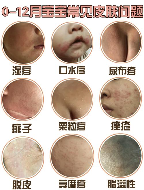 新生儿接种牛痘疫苗的最佳时间是什么时候?需要注意哪些事项?-第1张图片-郑州医学网 新生儿接种牛痘疫苗的最佳时间是什么时候?需要注意哪些事项?-第1张图片-郑州医学网