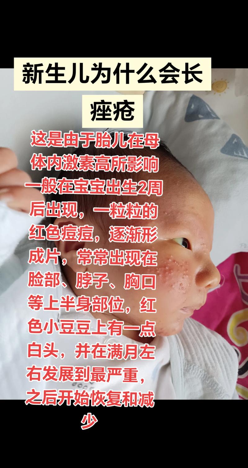 新生儿接种牛痘疫苗的最佳时间是什么时候?需要注意哪些事项?-第3张图片-郑州医学网 新生儿接种牛痘疫苗的最佳时间是什么时候?需要注意哪些事项?-第3张图片-郑州医学网