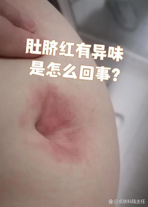 孕期肚脐眼周围不舒服,是正常生理反应还是异常信号?-第3张图片-郑州医学网 孕期肚脐眼周围不舒服,是正常生理反应还是异常信号?-第3张图片-郑州医学网