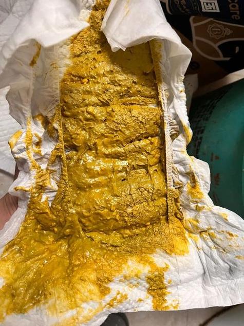 新生儿母乳便便图，不同阶段性状差异大，怎样算正常需警惕哪些异常？-第2张图片-郑州医学网