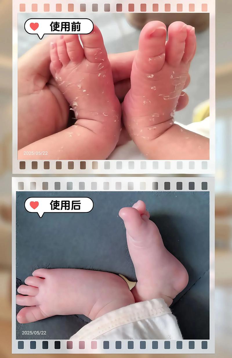 新生儿起皮是正常现象吗？该如何正确护理才能缓解？-第2张图片-郑州医学网