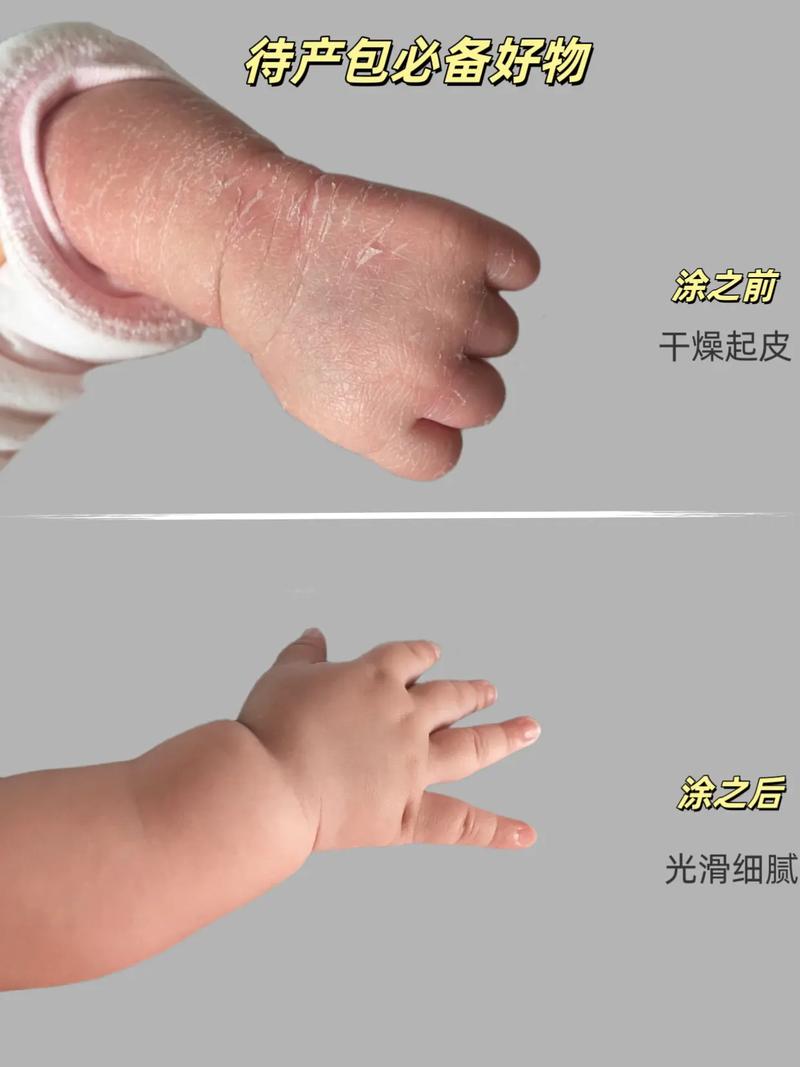新生儿起皮是正常现象吗？该如何正确护理才能缓解？-第3张图片-郑州医学网