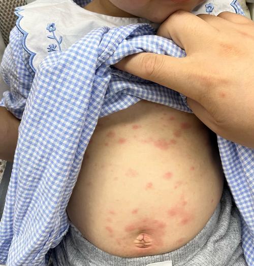 新生儿感染巨细胞病毒后会有哪些典型症状？家长该如何早期识别和应对？-第1张图片-郑州医学网