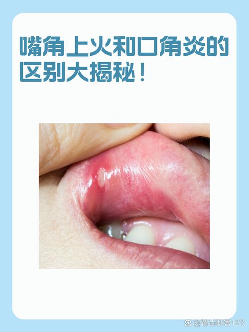 孕期上火嘴角溃烂怎么办？能用药吗？如何快速缓解又不影响胎儿？-第2张图片-郑州医学网