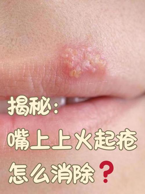 孕期上火嘴角溃烂怎么办?能用药吗?如何快速缓解又不影响胎儿?-第1张图片-郑州医学网 孕期上火嘴角溃烂怎么办?能用药吗?如何快速缓解又不影响胎儿?-第1张图片-郑州医学网