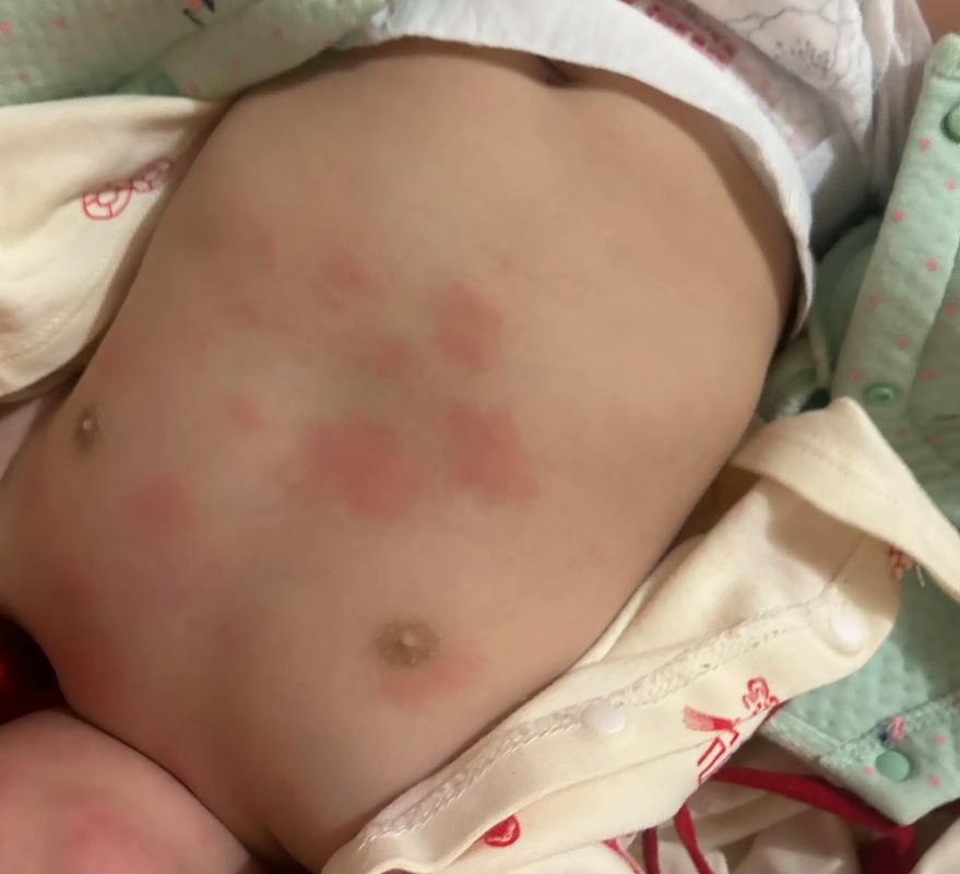 新生儿身上起红疹子带白尖是正常现象还是疾病信号？-第1张图片-郑州医学网