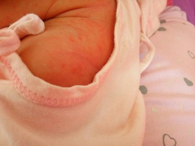 新生儿身上起红疹子带白尖是正常现象还是疾病信号？-第2张图片-郑州医学网