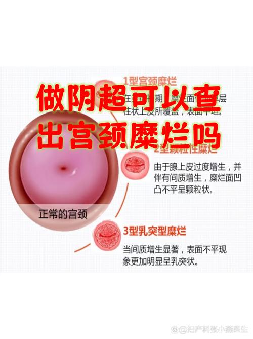 孕期检查必须做阴超吗？有没有必要和风险？-第3张图片-郑州医学网