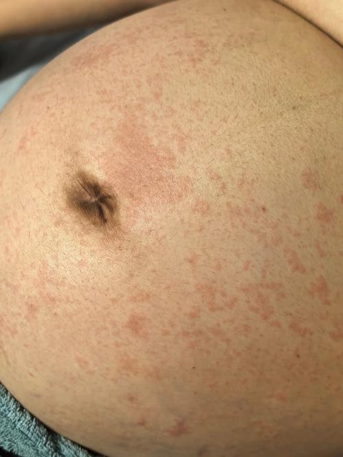 孕期血糖高是否真的会导致宝宝长湿疹？这两者之间到底存在什么关联？-第1张图片-郑州医学网