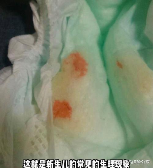 儿童尿液出现白色沉淀物是正常现象还是健康警报？需警惕哪些潜在问题？-第3张图片-郑州医学网