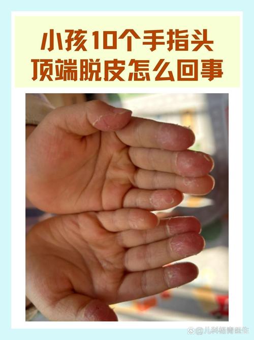 儿童手掉皮是什么原因-第1张图片-郑州医学网