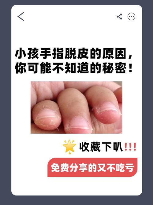 儿童手掉皮是什么原因-第2张图片-郑州医学网