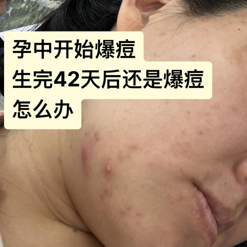 孕期痘痘产后多久能消失？有哪些科学方法能加速恢复？-第1张图片-郑州医学网