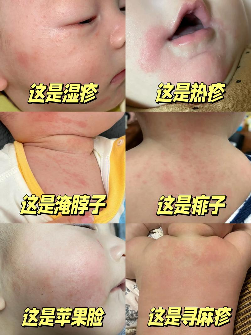 新生儿常见皮肤病配图-第1张图片-郑州医学网