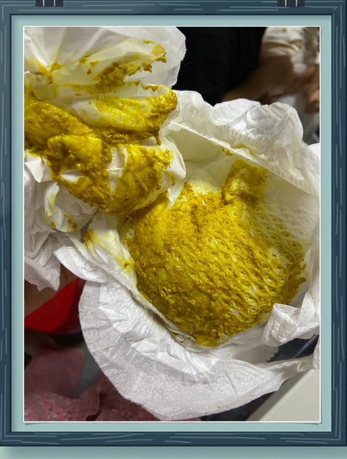 两个月的新生儿一天拉几次大便才算正常？家长该如何判断是否出现了腹泻或便秘的情况？-第3张图片-郑州医学网