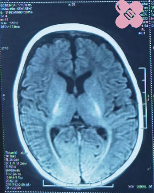 核磁共振检查新生儿脑改变有何临床意义及诊断价值？-第1张图片-郑州医学网