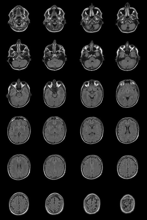 核磁共振检查新生儿脑改变有何临床意义及诊断价值？-第2张图片-郑州医学网