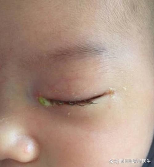 新生儿左眼流泪眼屎多是上火还是鼻泪管堵塞？该如何处理？-第1张图片-郑州医学网