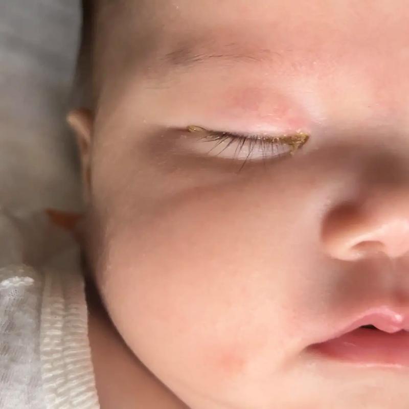 新生儿左眼流泪眼屎多是上火还是鼻泪管堵塞？该如何处理？-第3张图片-郑州医学网