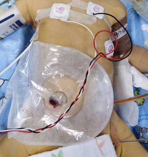 新生儿休克的临床表现-第2张图片-郑州医学网 新生儿休克的临床表现-第2张图片-郑州医学网