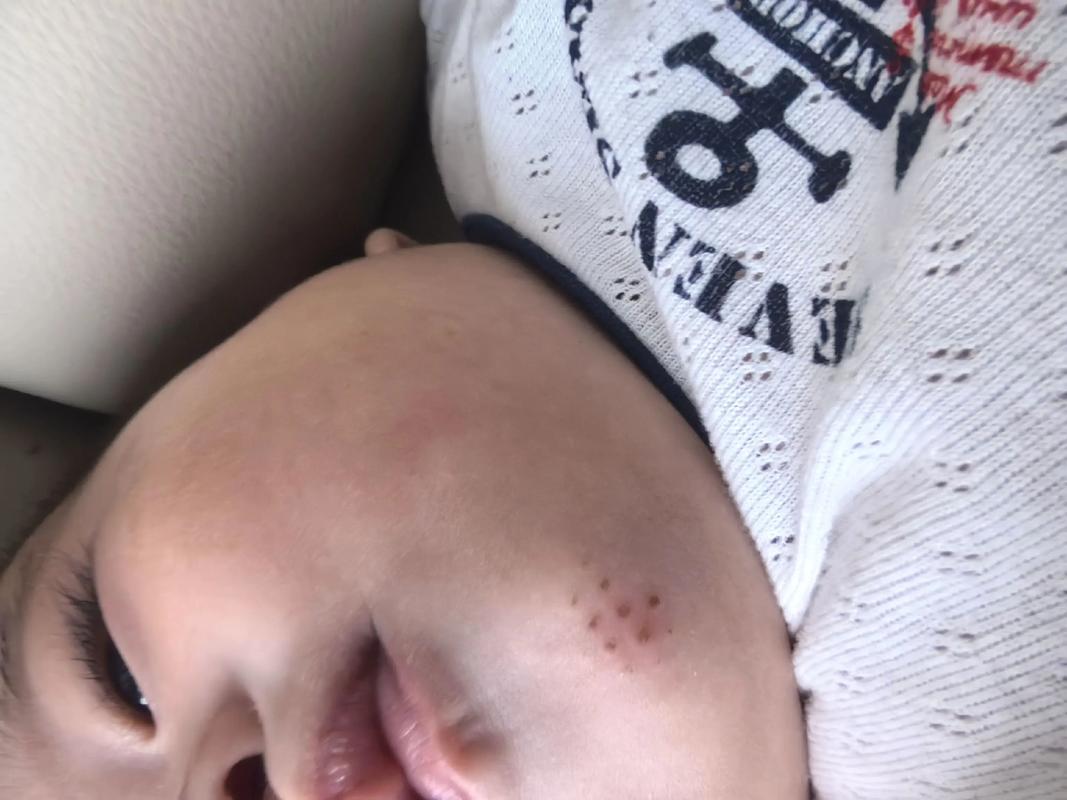 新生儿宝宝下巴出现硬块是什么原因？需要担心吗？-第3张图片-郑州医学网