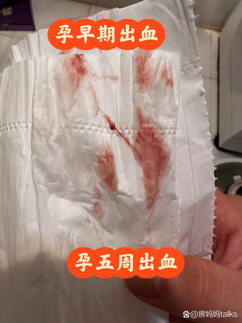 孕期妇科炎症引发流血，会对胎儿造成哪些不良影响？-第1张图片-郑州医学网