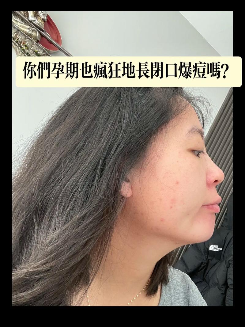 怀孕期间长痘痘怎么办？安全有效的祛痘方法有哪些？-第1张图片-郑州医学网