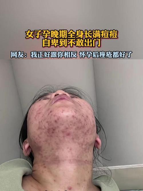 怀孕期间长痘痘怎么办？安全有效的祛痘方法有哪些？-第2张图片-郑州医学网