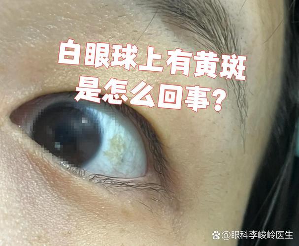 新生儿黄疸白眼球发黄是正常现象还是异常信号？需要干预吗？-第1张图片-郑州医学网