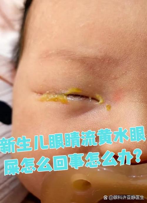 新生儿黄疸白眼球发黄是正常现象还是异常信号？需要干预吗？-第2张图片-郑州医学网