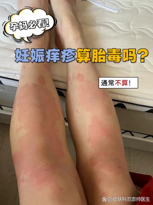 怀孕期间突发湿疹，孕妇该如何安全有效应对？-第2张图片-郑州医学网