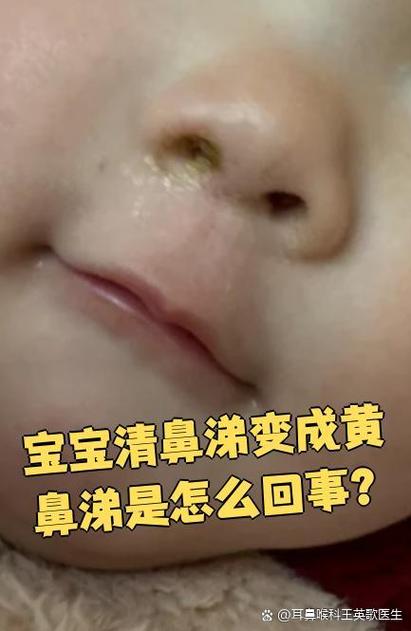 新生儿鼻子有鼻涕但不会擤鼻涕，家长该如何正确处理和护理？-第2张图片-郑州医学网