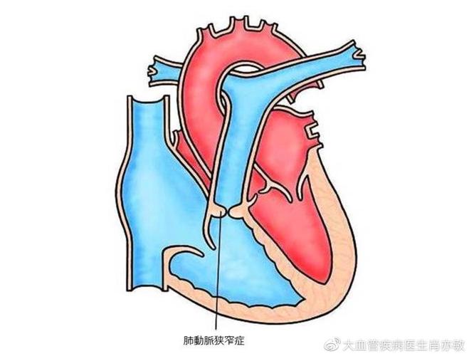 新生儿肺动脉重度狭窄有哪些症状及治疗方法？-第2张图片-郑州医学网
