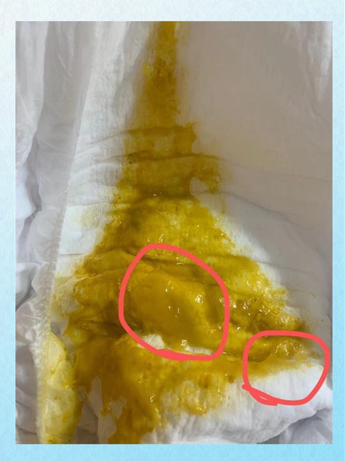 新生儿大便呈果冻状正常吗?附图片详解不同情况下的应对方法-第1张图片-郑州医学网 新生儿大便呈果冻状正常吗?附图片详解不同情况下的应对方法-第1张图片-郑州医学网