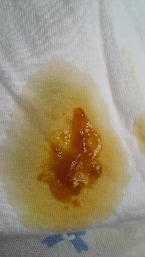 新生儿大便呈果冻状正常吗？附图片详解不同情况下的应对方法-第2张图片-郑州医学网