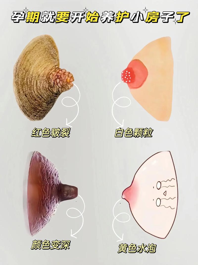 怀孕期间乳头出现脏东西是正常现象吗？需要特殊处理吗？-第2张图片-郑州医学网
