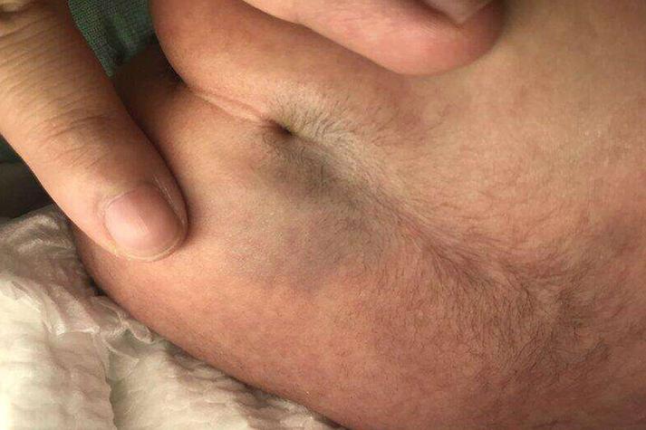 新生儿隐性脊柱裂有哪些容易被忽视的早期表现？-第1张图片-郑州医学网