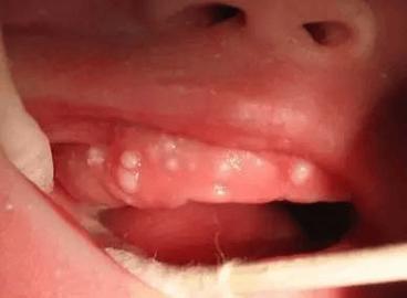 新生儿下面白色粘稠物是什么？需要清理吗？会影响健康吗？-第1张图片-郑州医学网