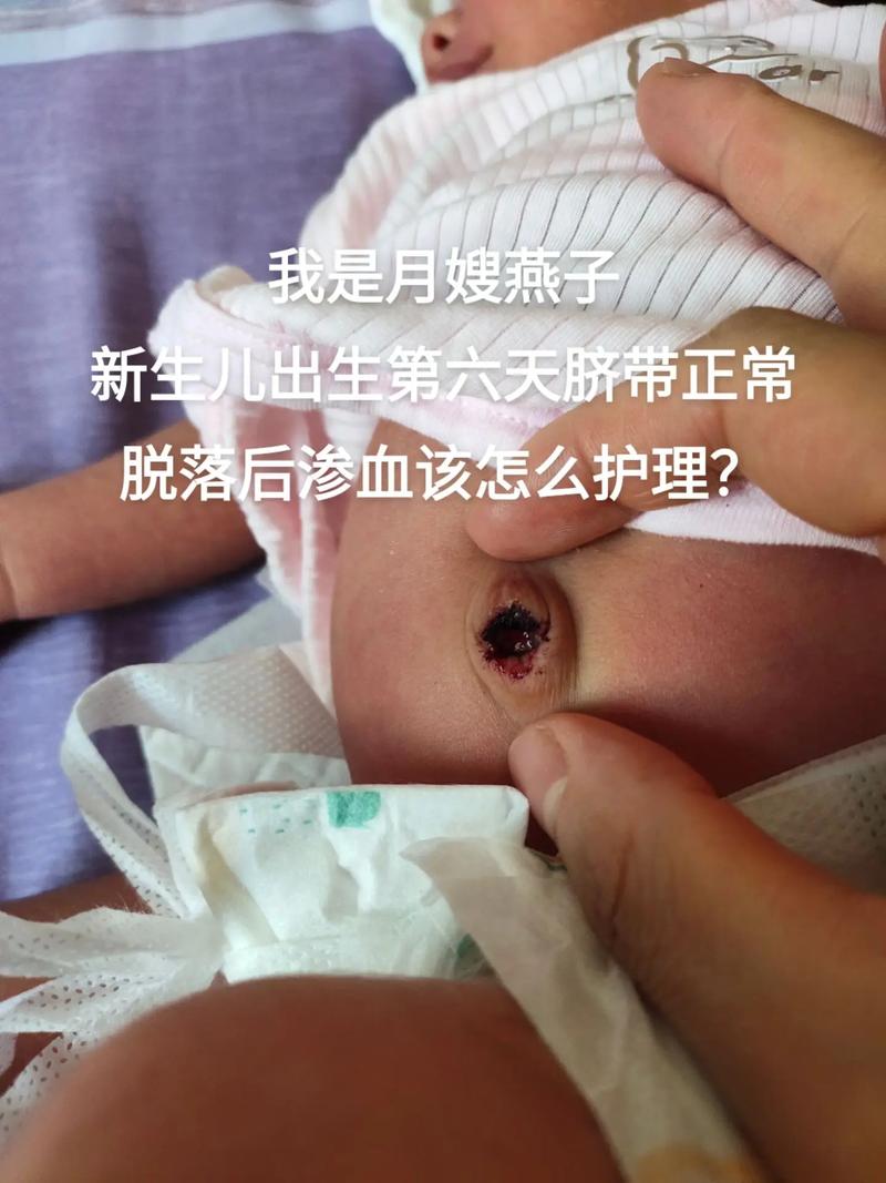 新生儿脐带脱落后出血怎么办？需要立即就医还是在家观察处理？-第1张图片-郑州医学网
