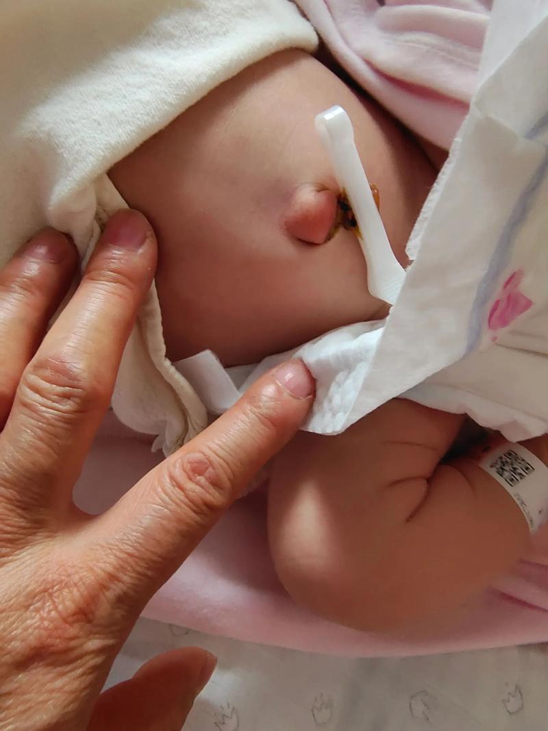 新生儿脐带脱落后出血怎么办？需要立即就医还是在家观察处理？-第3张图片-郑州医学网