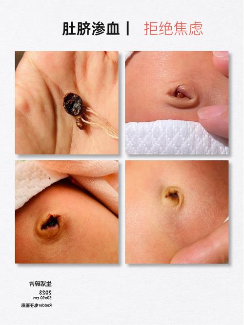 新生儿脐带脱落后出血怎么办？需要立即就医还是在家观察处理？-第2张图片-郑州医学网