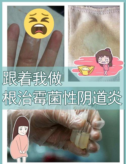 备孕期间查出霉菌感染，不用药怕影响怀孕，用药又怕伤胎儿，到底该怎么办？-第2张图片-郑州医学网